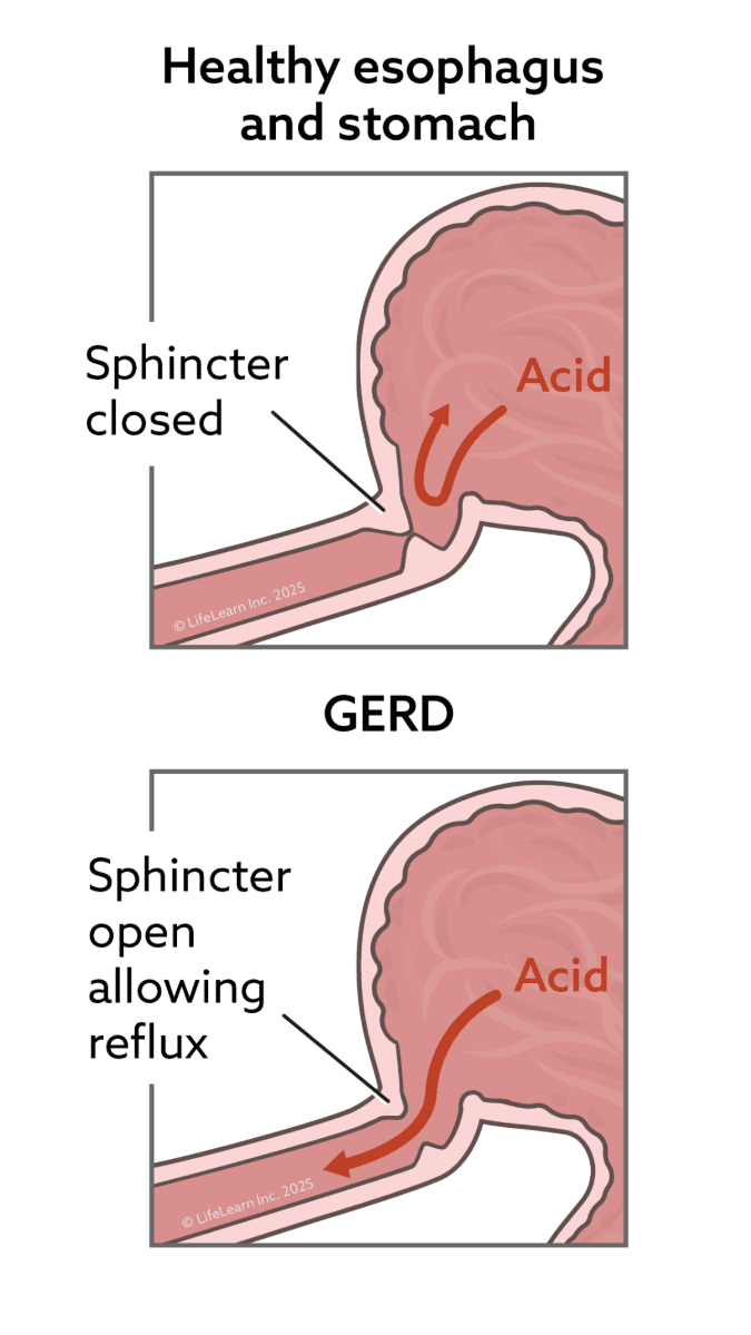 diagram showing healthy esophagus and stomach vs one with GERD